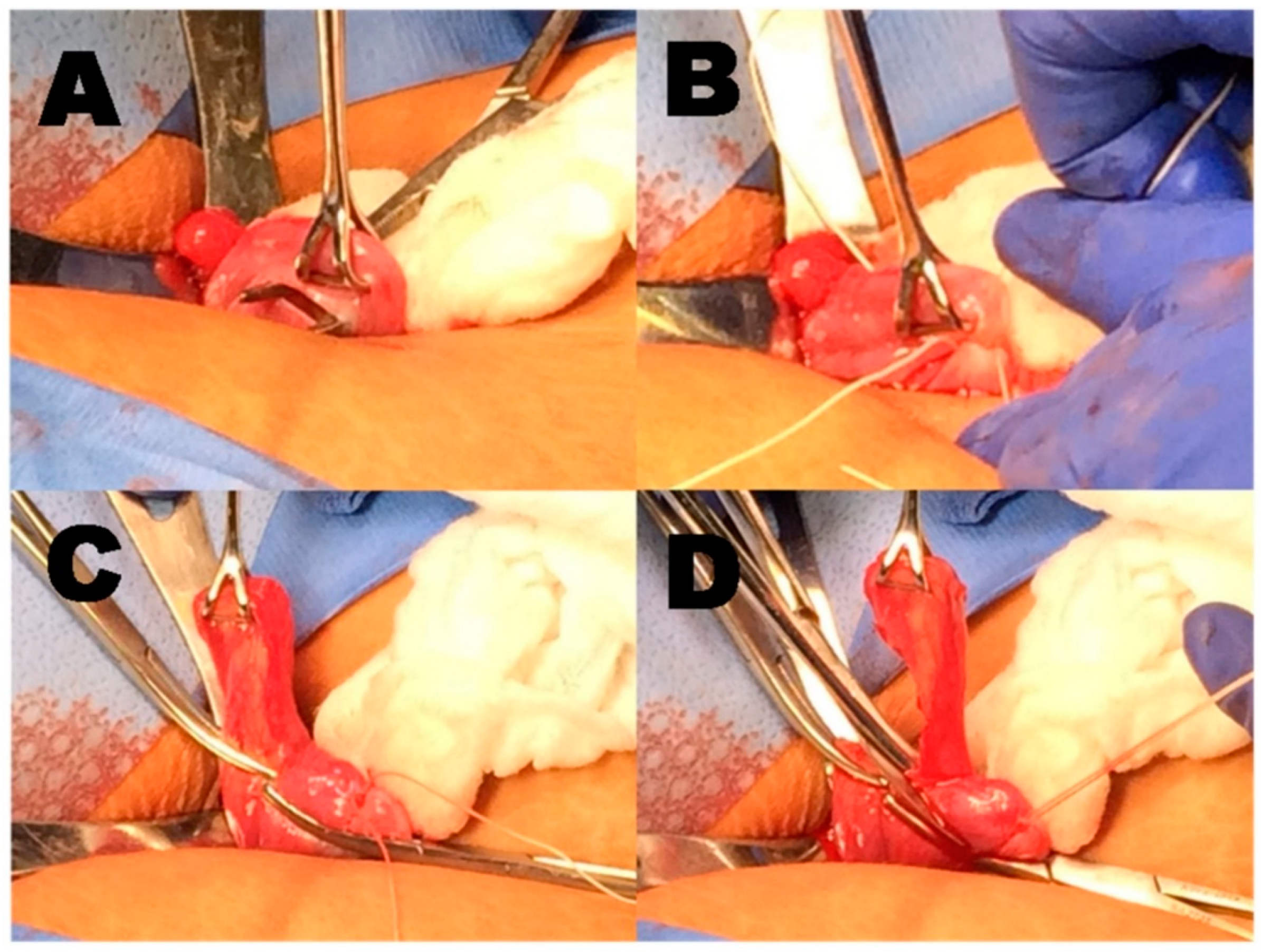 Reprod. Med. | Free Full-Text | A Standardized Protocol for Post-Partum  Salpingectomy with Suture Ligation: A Prospective Feasibility Study