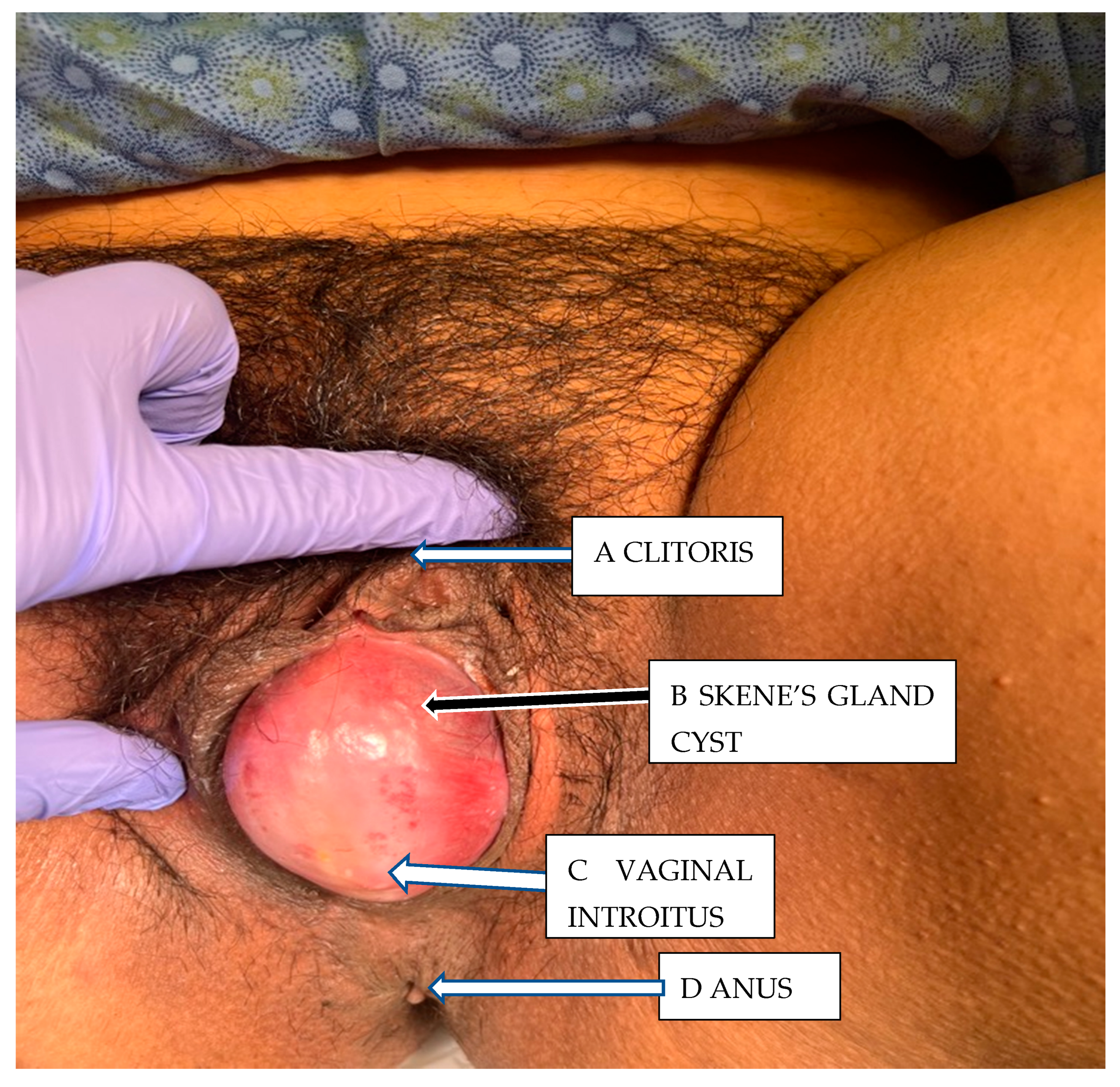 Symptomatic Giant Skene’s Gland Cyst During Second Trimester  Pregnancy and Surgical Excision: A Case Report
