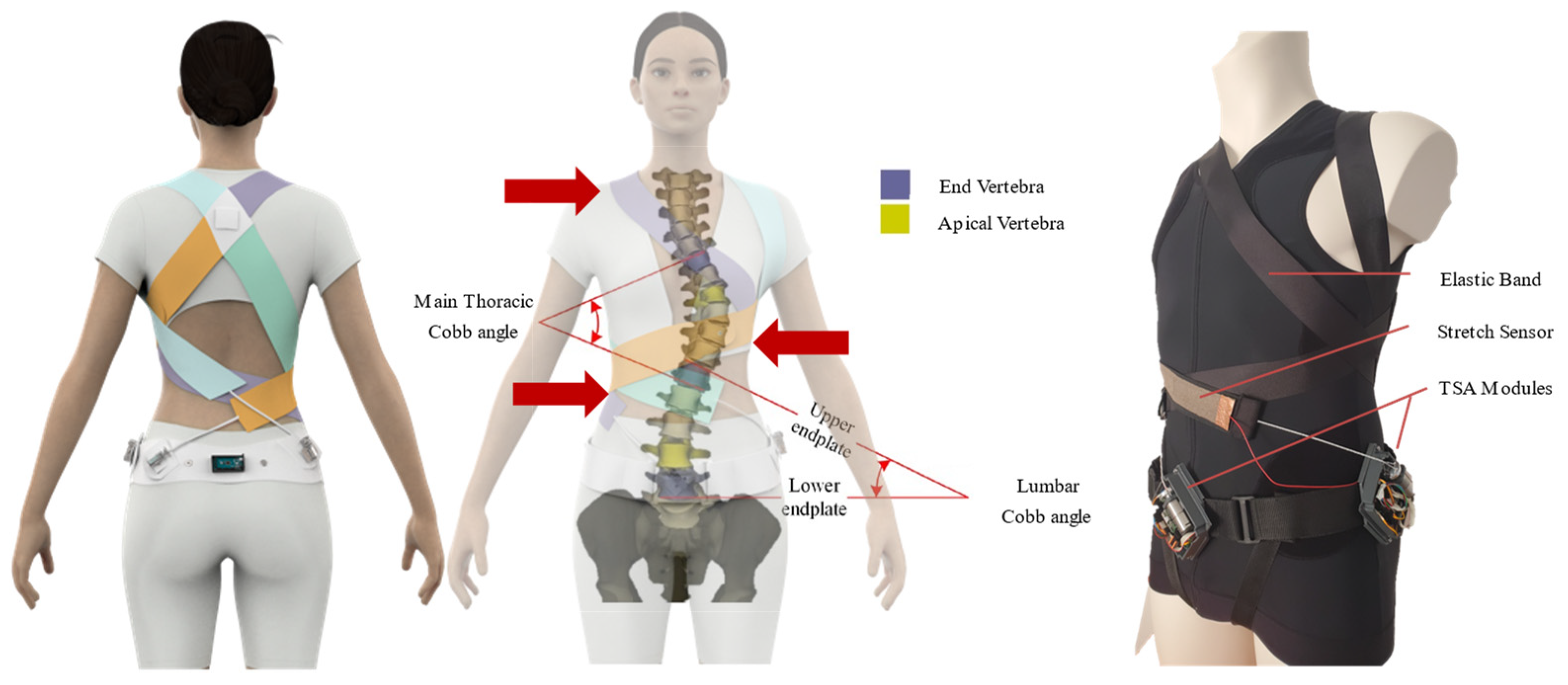 Lumbar (A), Thoracolumbar (B) and Thoracic (C) Boston Brace.