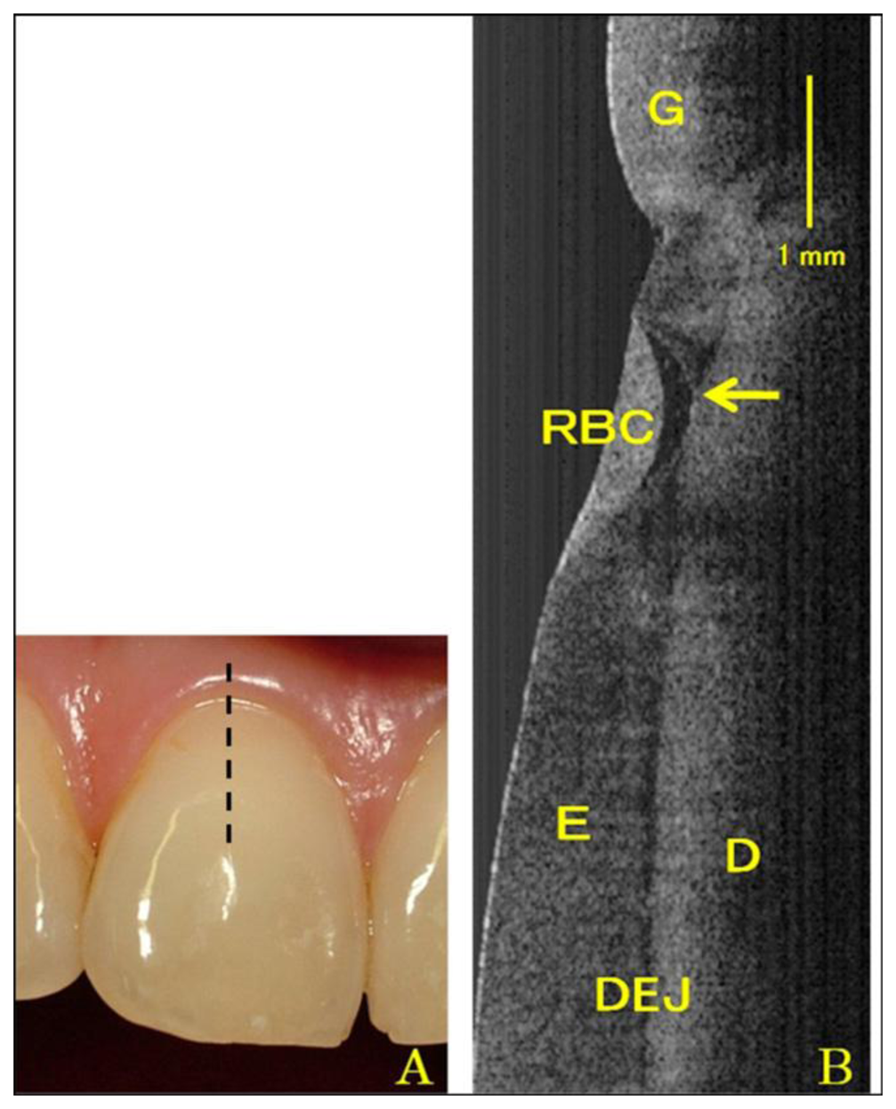 Sensors Free FullText Dental Optical Coherence Tomography