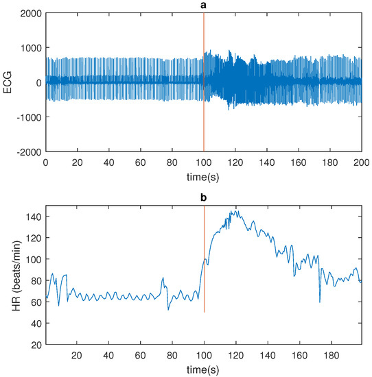 Sensors Free Full Text Automated Epileptic Seizure Detection Based On Wearable Ecg And Ppg In A Hospital Environment Html