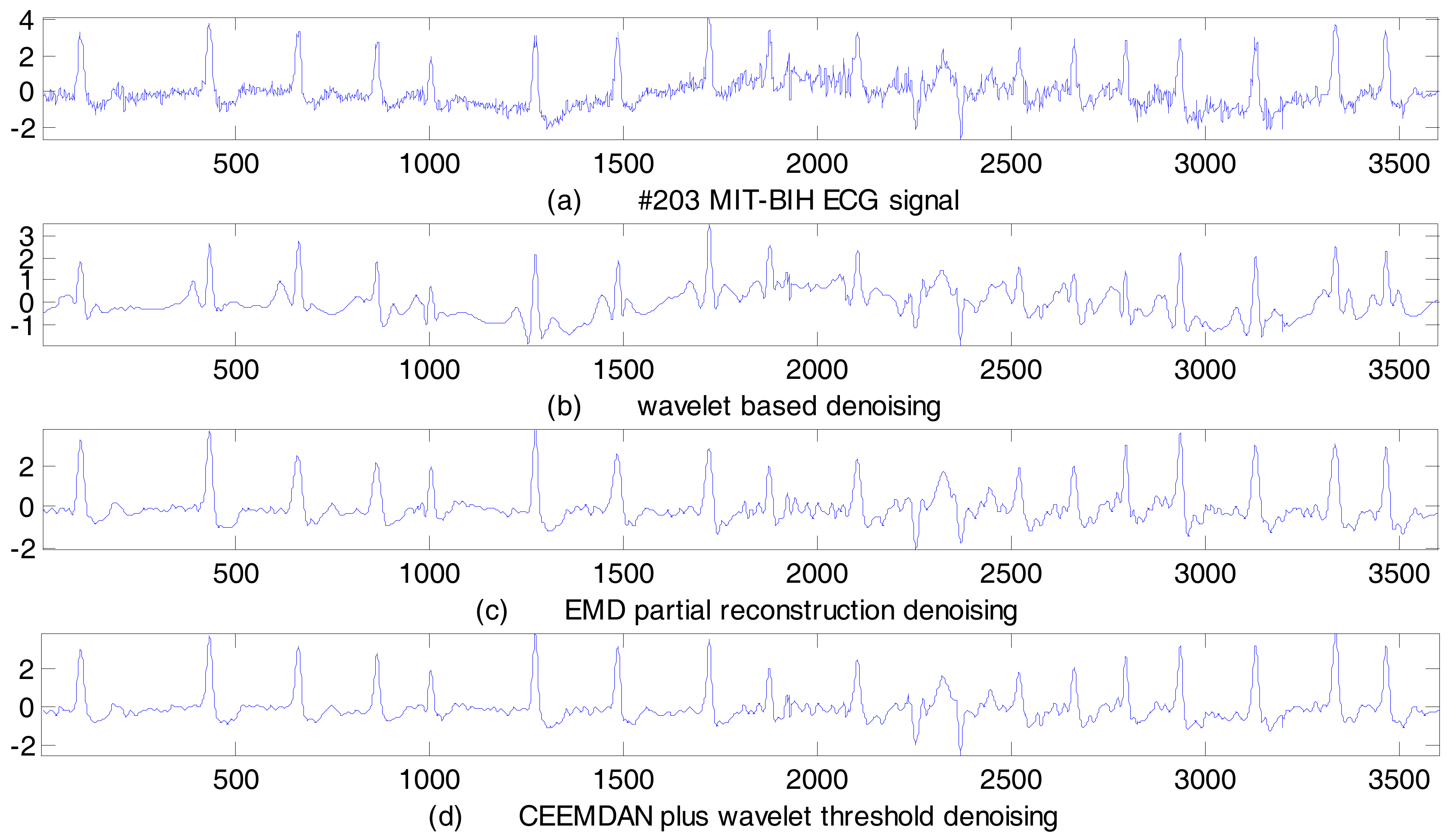 Sensors Free FullText ECG Signal Denoising and Baseline Wander