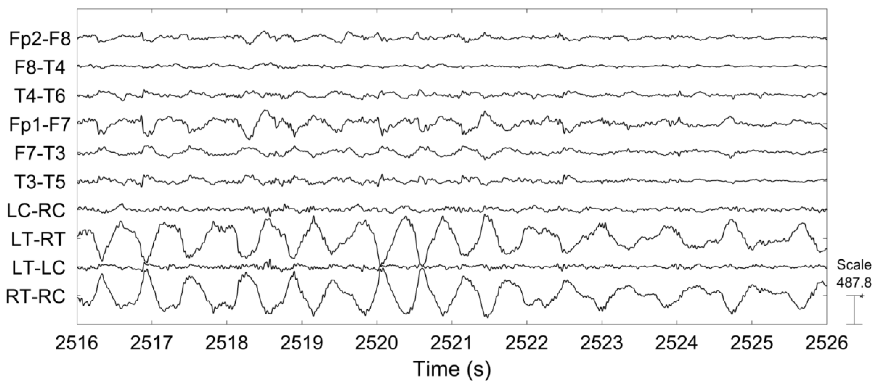 abnormal eeg abnormal eeg