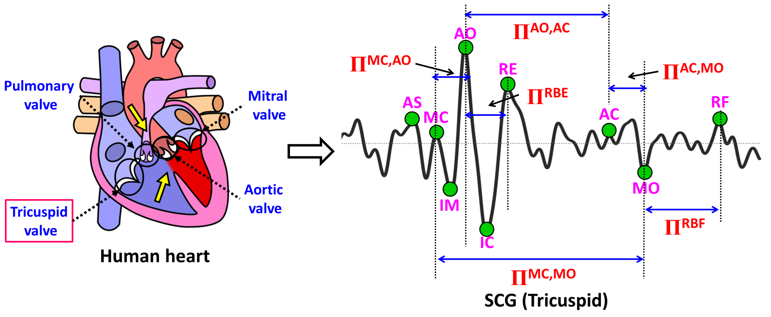 ECG removal technique.