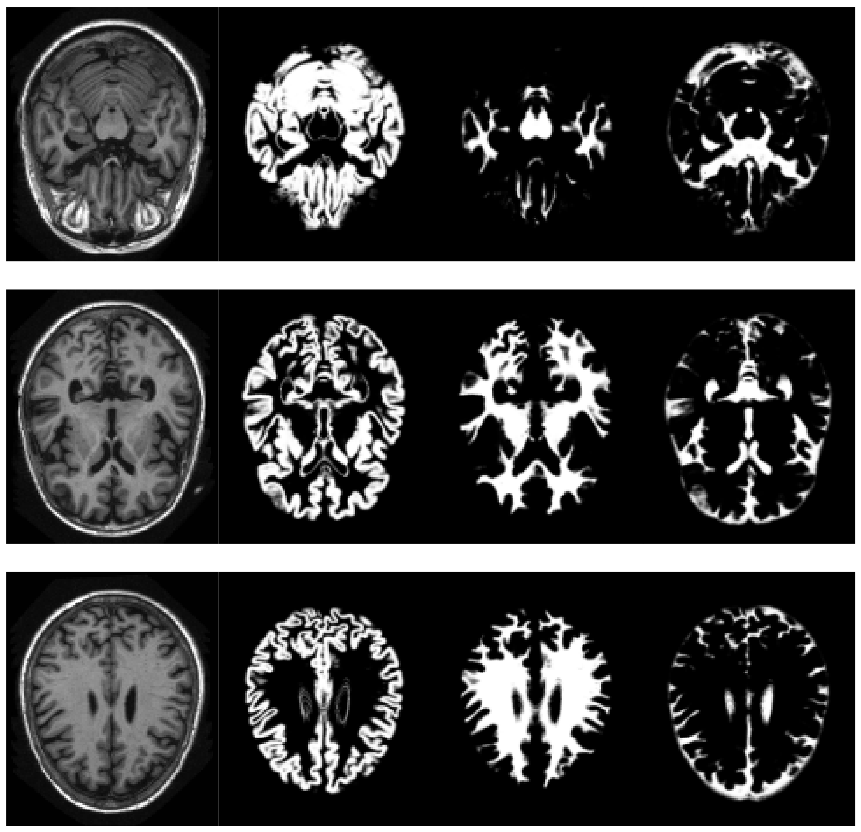 sensors free full text supervoxels based histon as a new alzheimer s disease imaging biomarker html