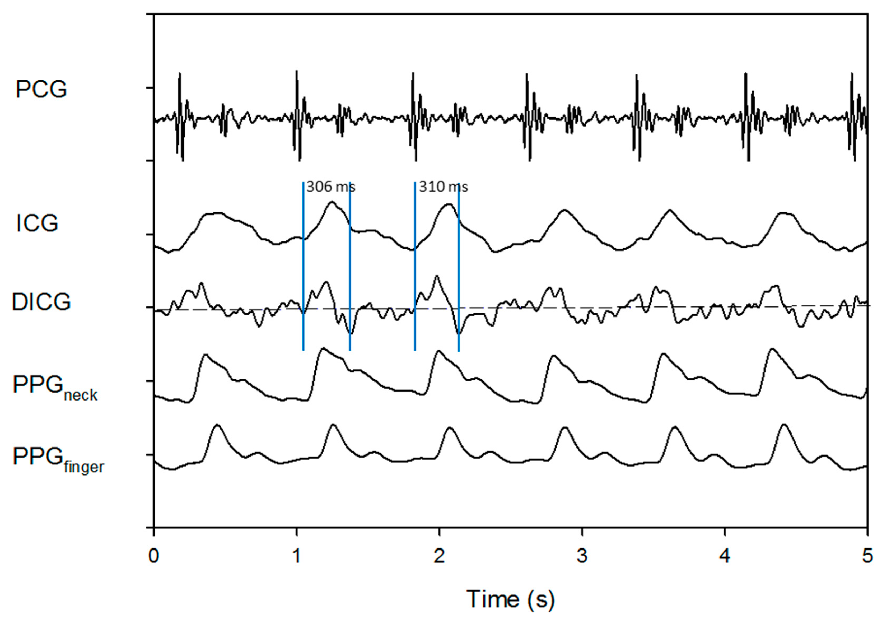 Sensors | Free Full-Text | Improvement of Left Ventricular Ejection Time Measurement in the Cardiography Combined with the Reflection Photoplethysmography