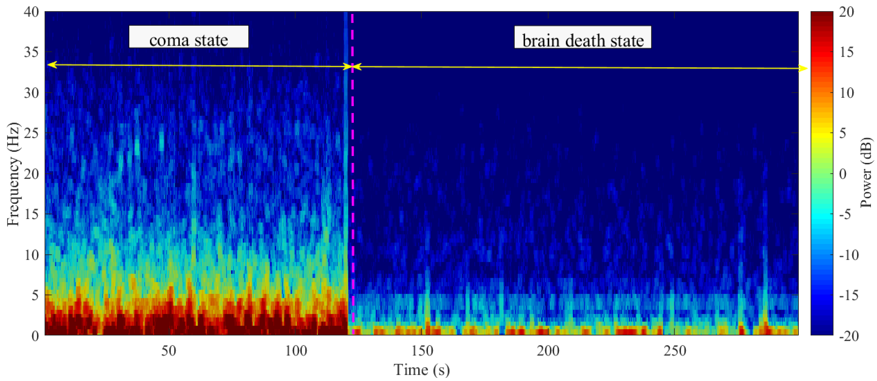 What is the Difference Between a Coma and Brain Death?