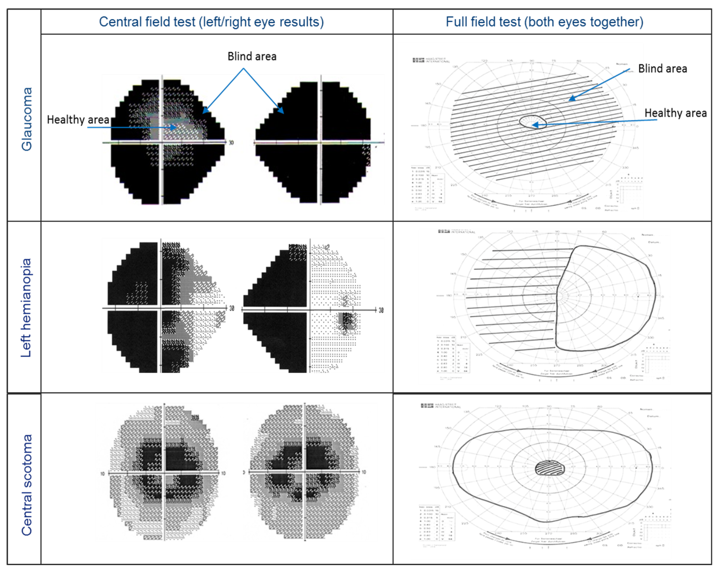 Sensors | Free Full-Text | A Smart Context-Aware Hazard Attention System to Help People with Peripheral Vision Loss | HTML Sensors | Free Full-Text | A Smart Context-Aware Hazard Attention System to Help People with Peripheral Vision Loss | HTML