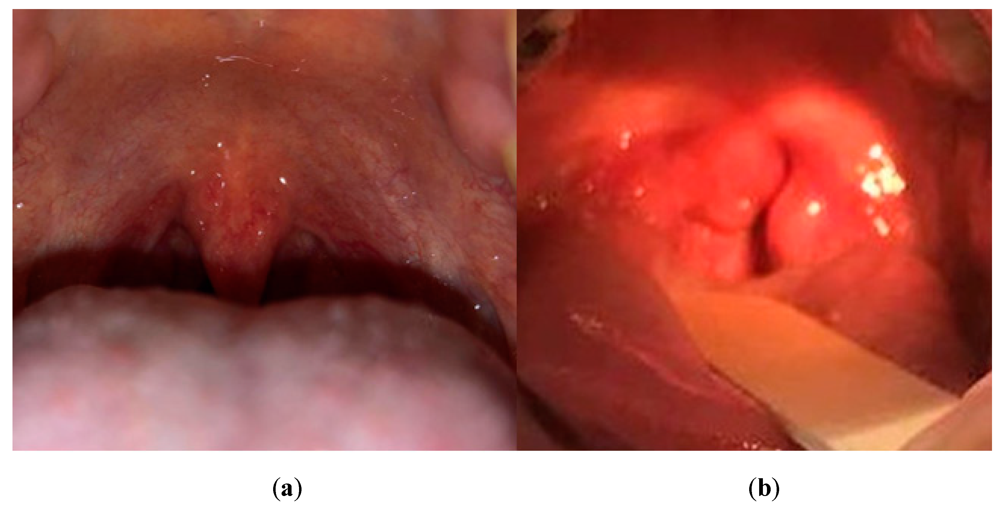 Streptococcal Throat Infections