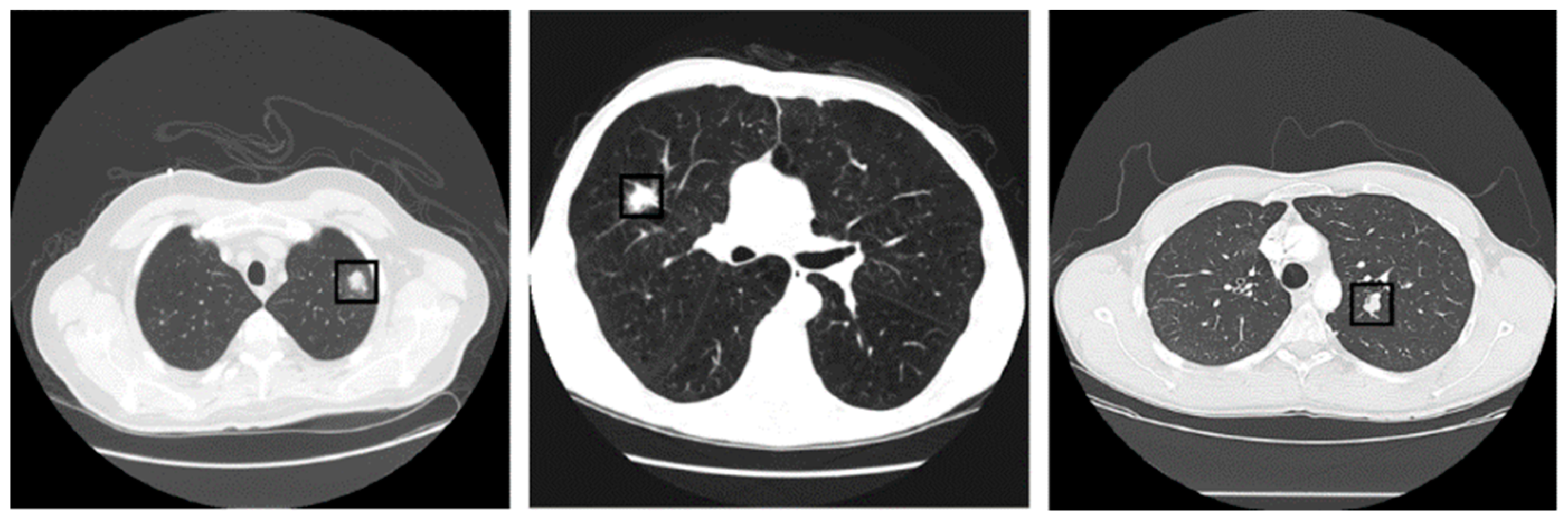 icd 10 code copd with acute bronchitis