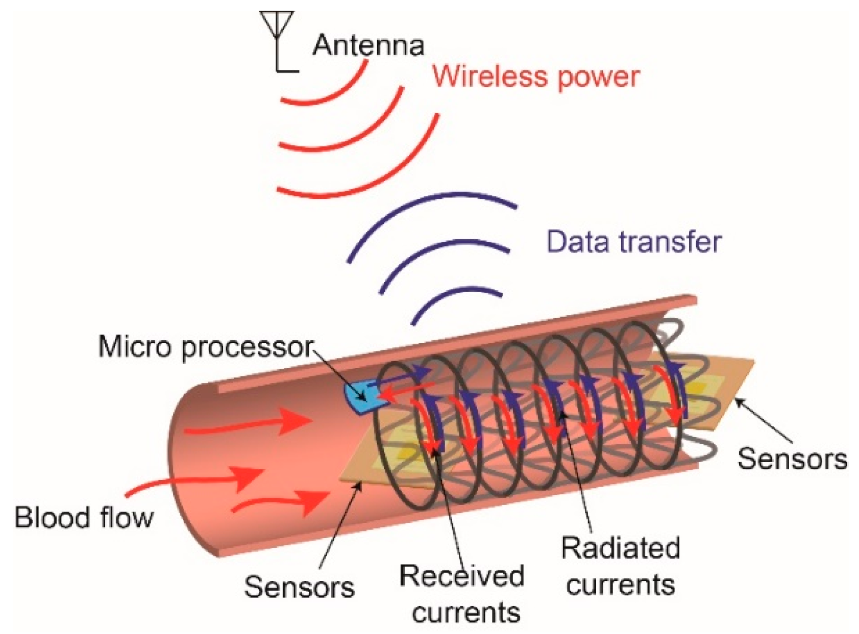 Sensors Free FullText A SingleConnector Stent Antenna for Intravascular Monitoring