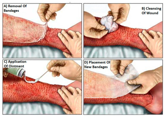 burn bandages