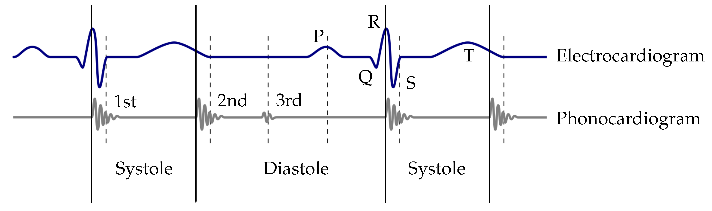 Sensors Free Full Text A Robust And Real Time Capable Envelope Based Algorithm For Heart Sound Classification Validation Under Different Physiological Conditions