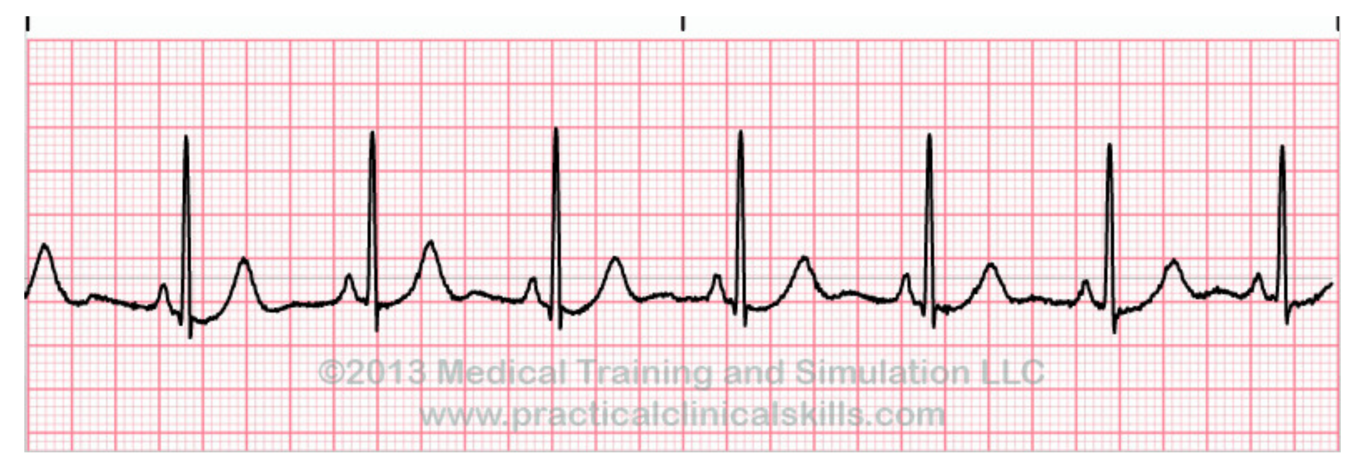 Sensors Free Full Text A Survey Of Heart Anomaly Detection Using Ambulatory Electrocardiogram Ecg Html