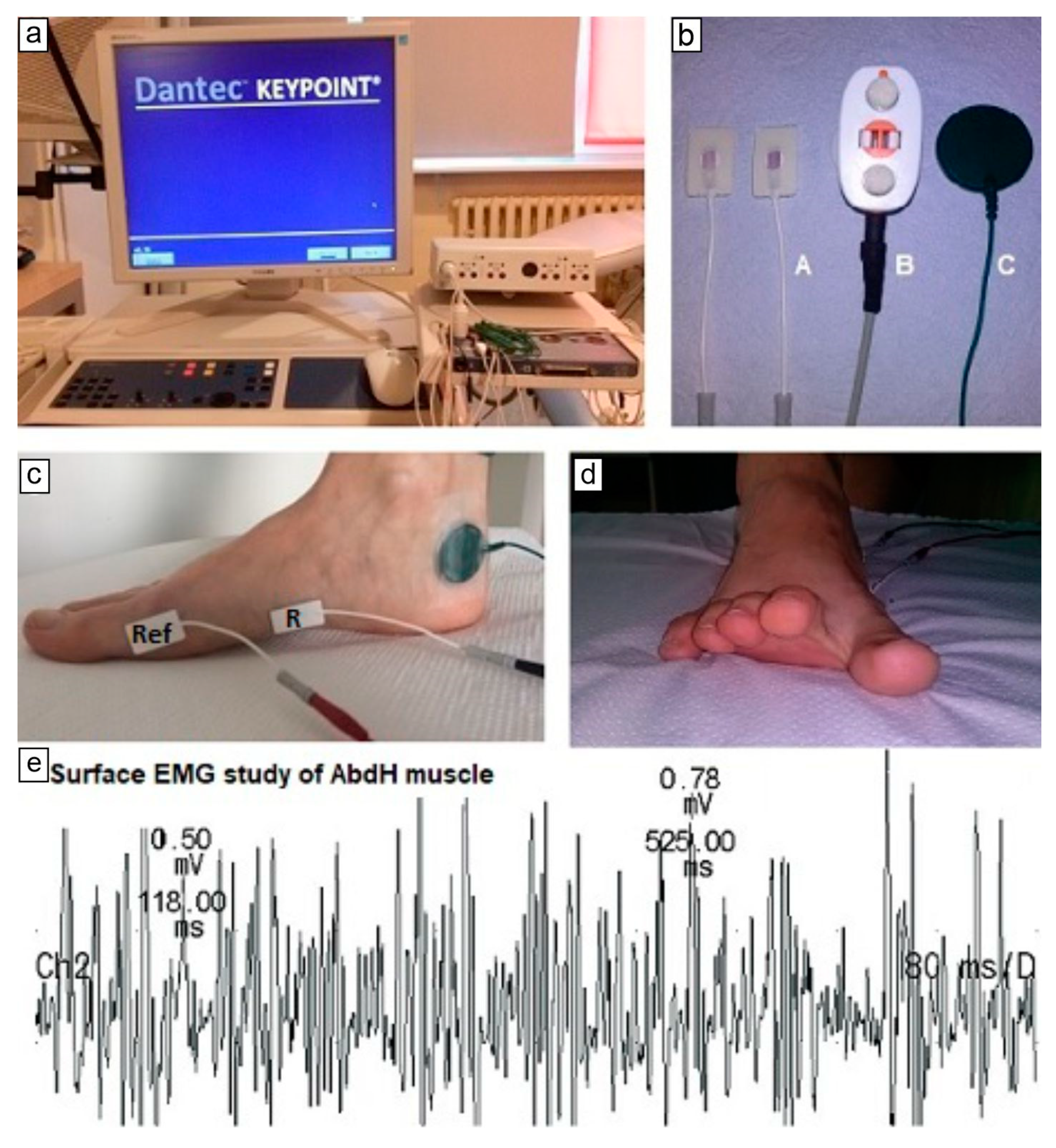 Sensors | Free Full-Text | Muscle Activity Detectors—Surface  Electromyography in the Evaluation of Abductor Hallucis Muscle