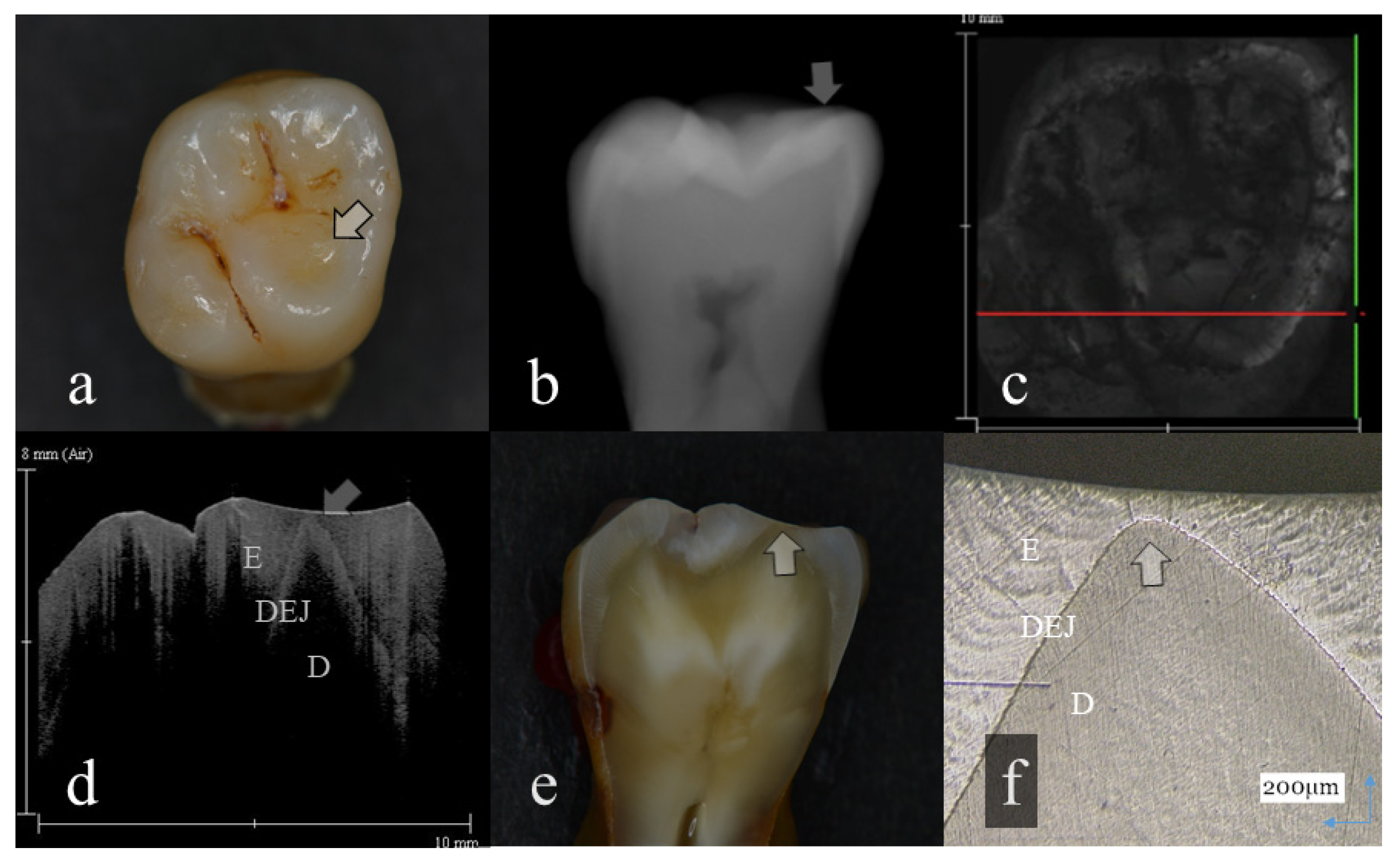 Sensors Free FullText Diagnosis of Occlusal Tooth Wear Using 3D