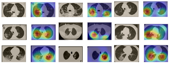 Sensors | Free Full-Text | Explainable COVID-19 Detection Using Chest ...