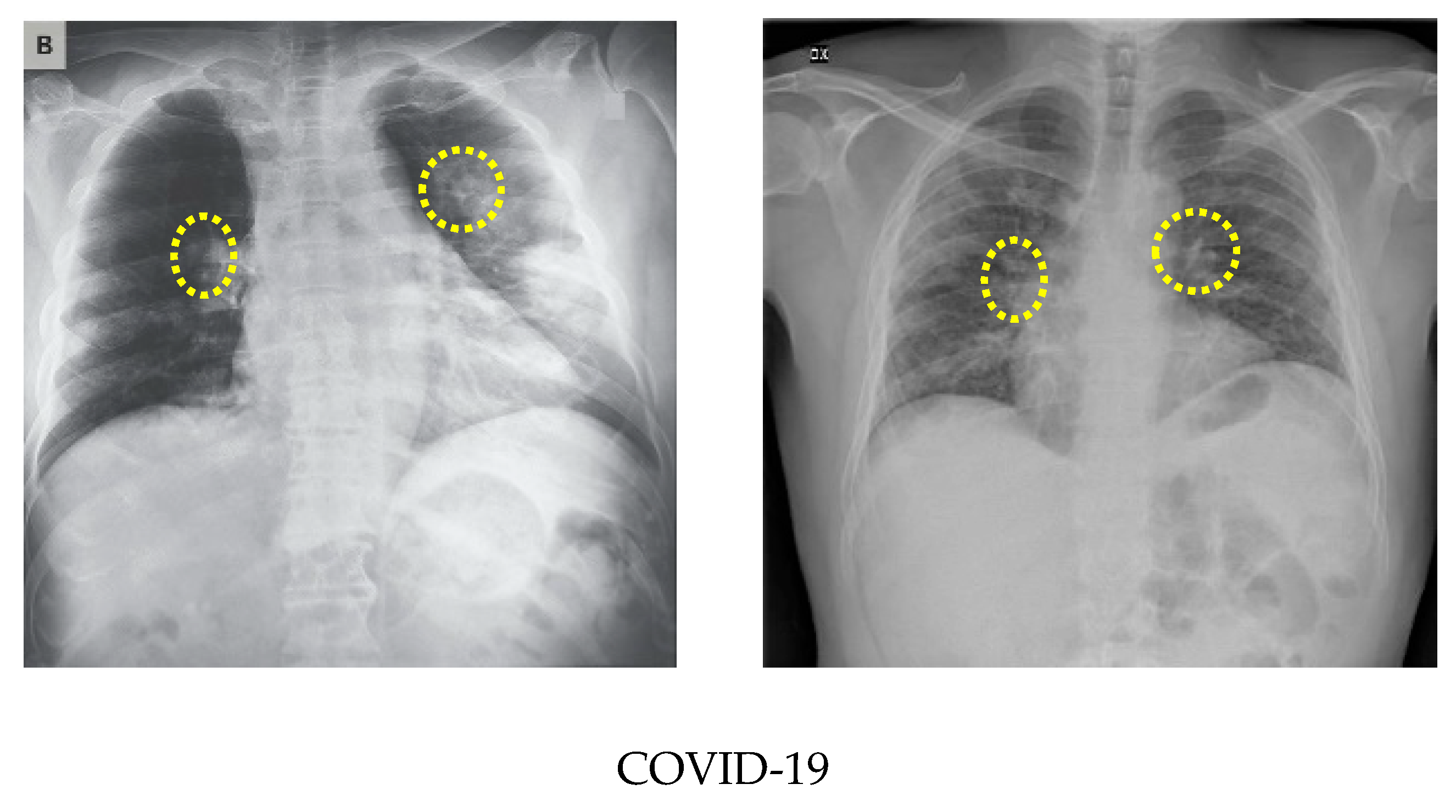 Sensors Free FullText COVID19 Detection from Chest Xray Images