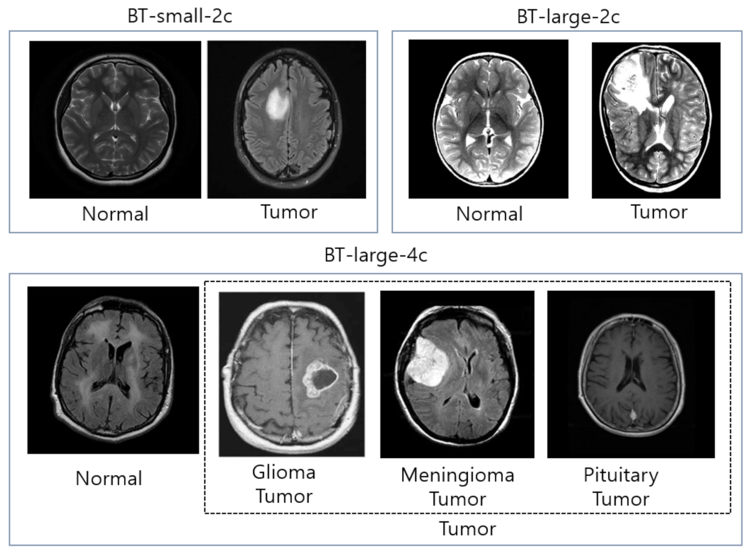 case study 69 brain tumor