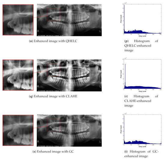 Panoramic Dental Radiography Image Enhancement Using