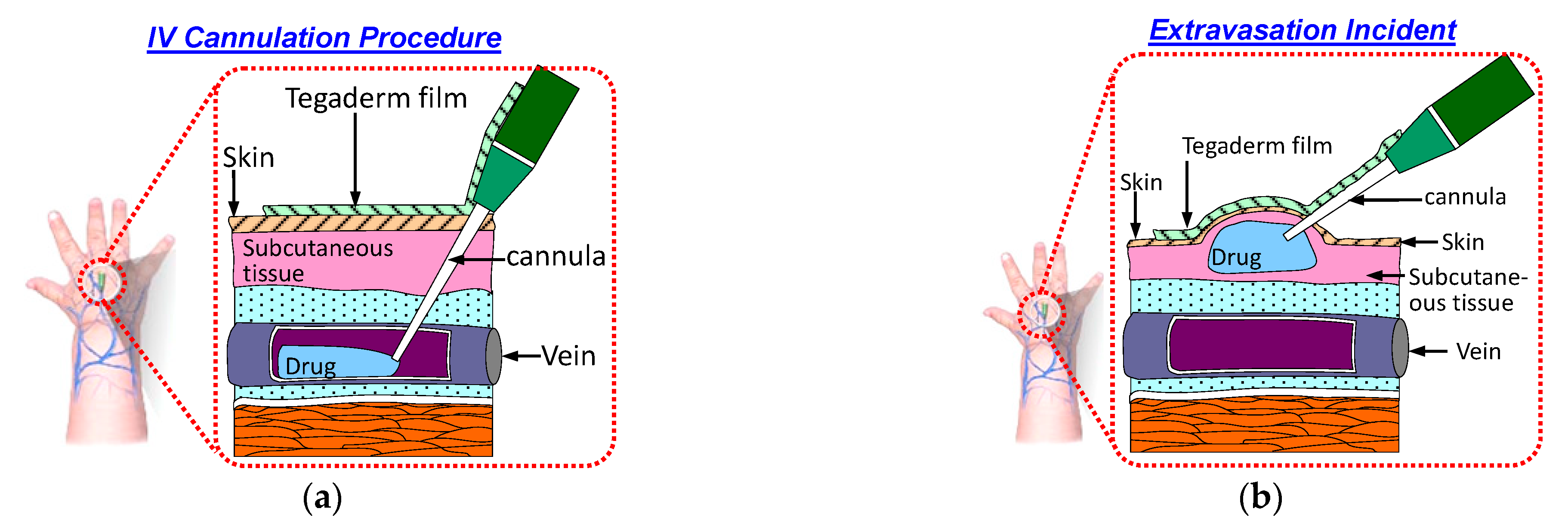 Sensors | Free Full-Text | Novel Conformal Skin Patch with Embedded  Thin-Film Electrodes for Early Detection of Extravasation