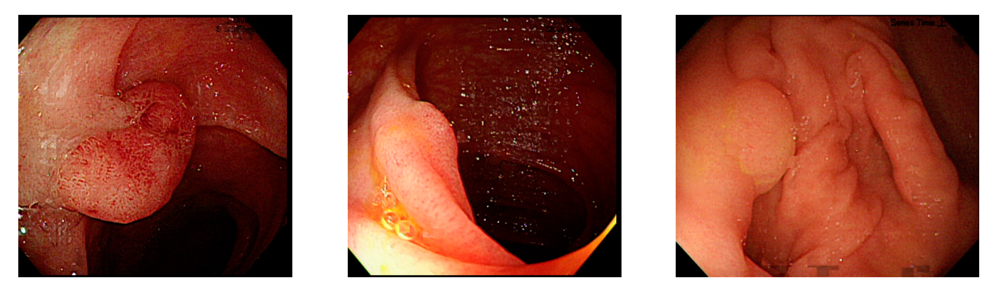 vestibularis papillomatosis szúró