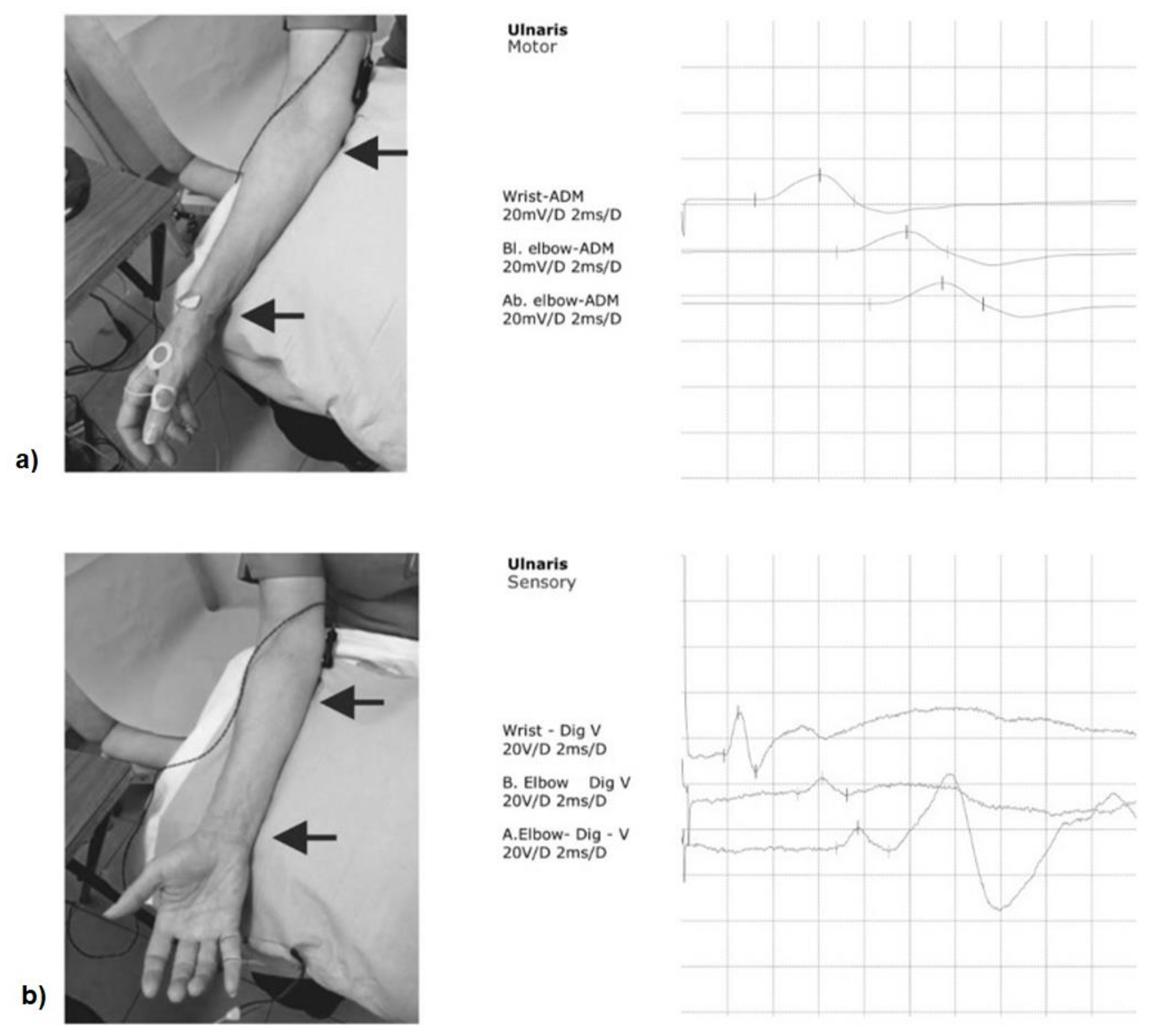 Sensors Free FullText The Effect of Local Cooling at the Elbow on
