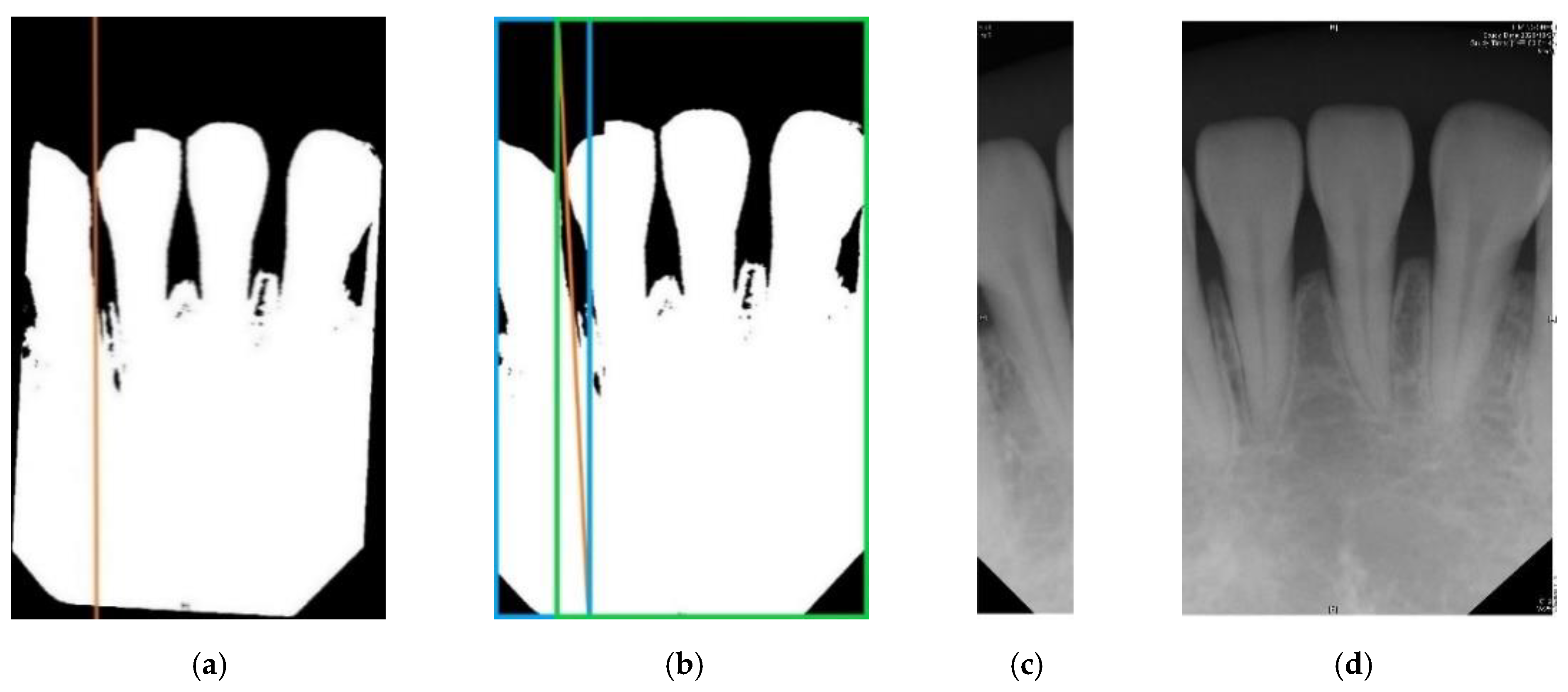 sensors free full text detection of dental apical lesions using cnns on periapical radiograph html