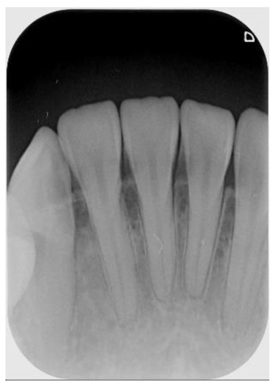 sensors free full text detection of dental apical lesions using cnns on periapical radiograph html