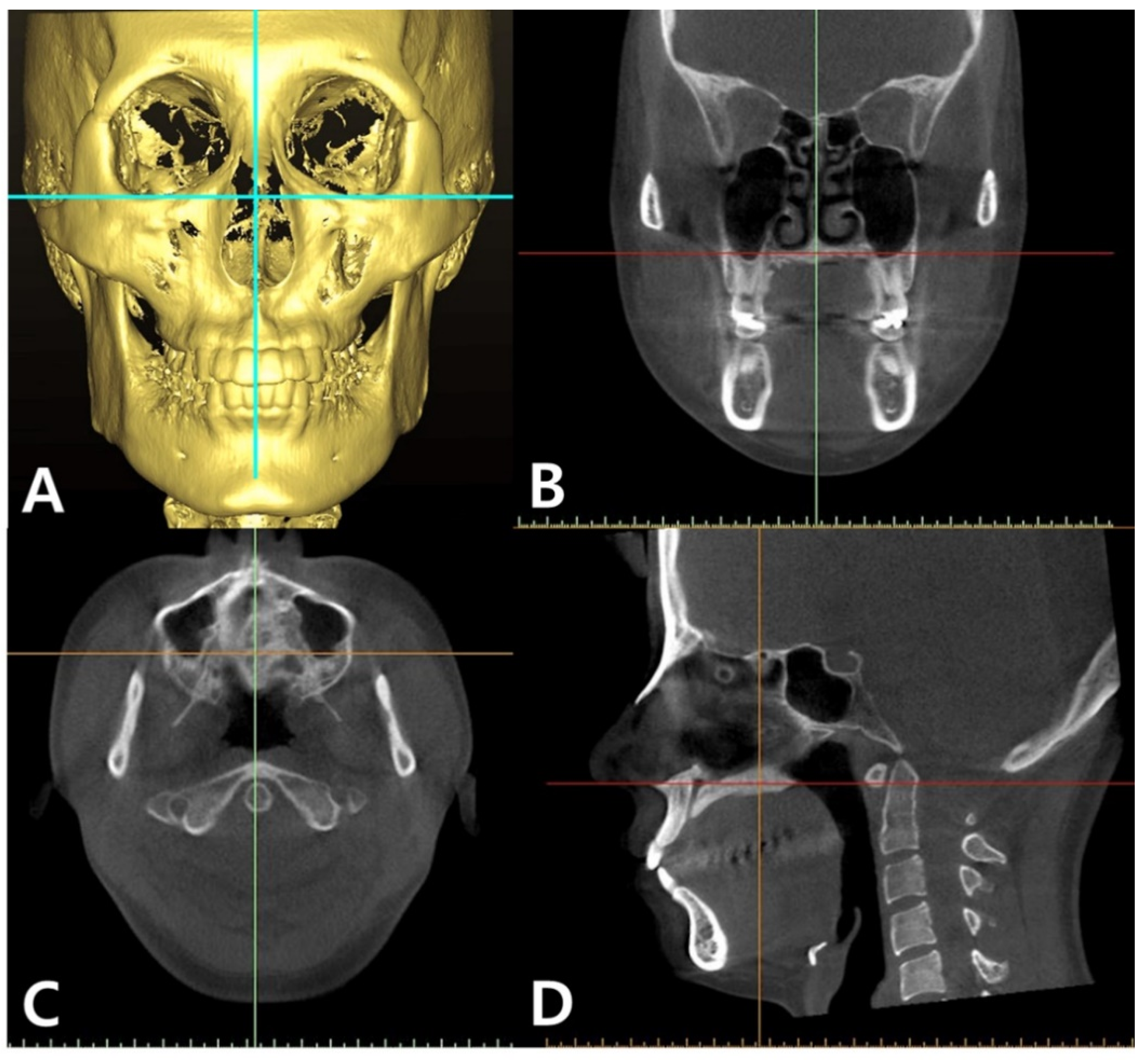 Sensors Free Full-text A Cbct Evaluation Of Midpalatal Bone Density In Various Skeletal Patterns