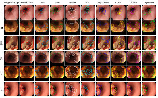 Sensors Free Full Text Multi Task Model For Esophageal Lesion Analysis Using Endoscopic Images Classification With Image Retrieval And Segmentation With Attention Html