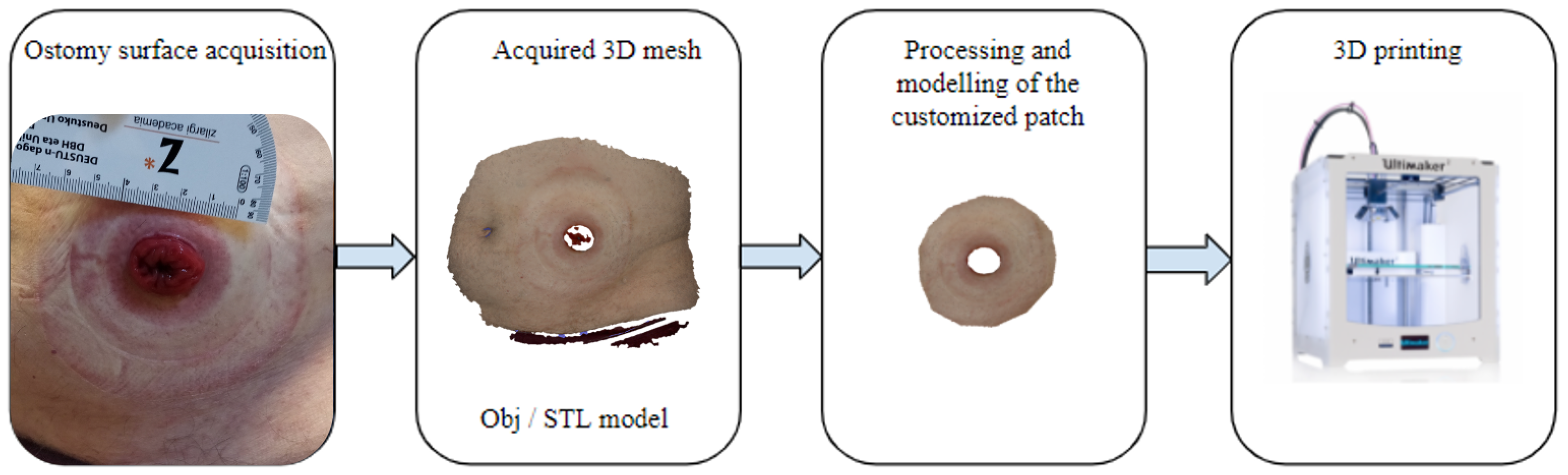 Odapt, a 3D Printed Disc for Ostomy Bags That Does Not Cause