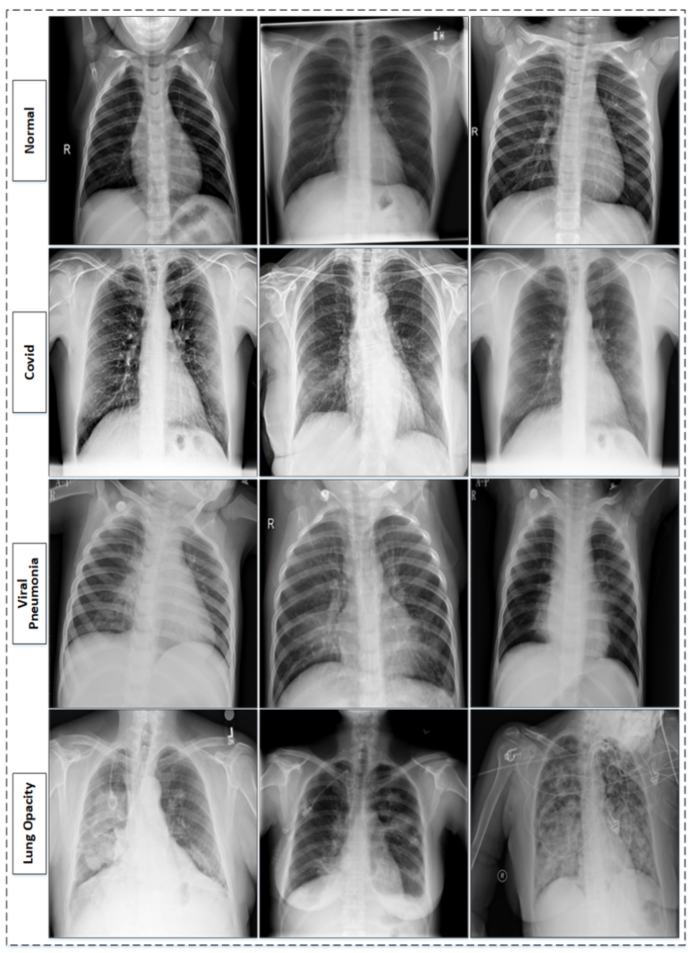 Sensors Free Full-Text Chest X-ray Classification For The, 52% OFF