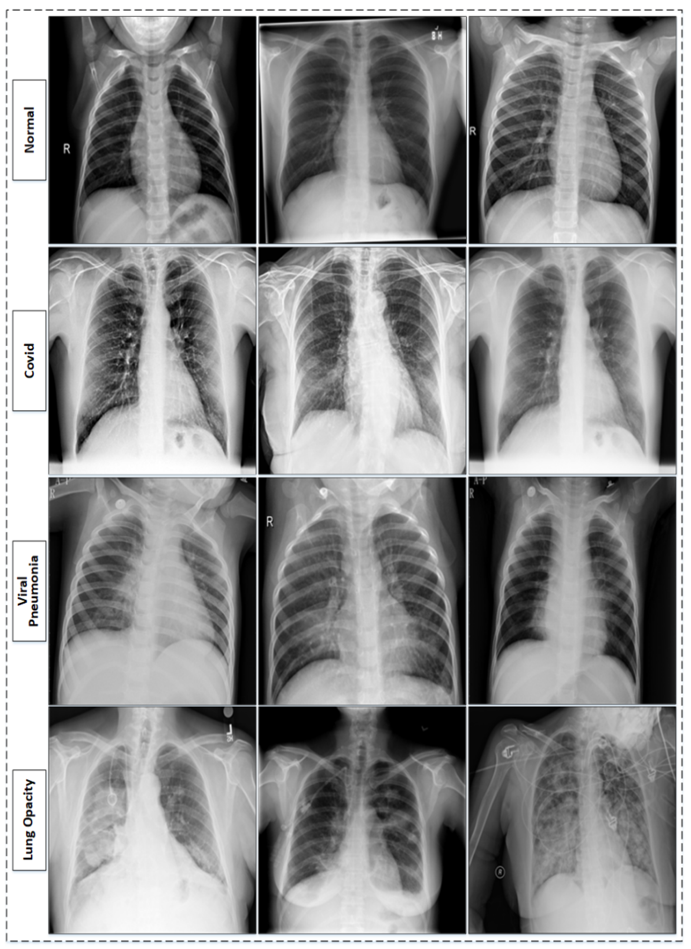 chest x ray pneumonia