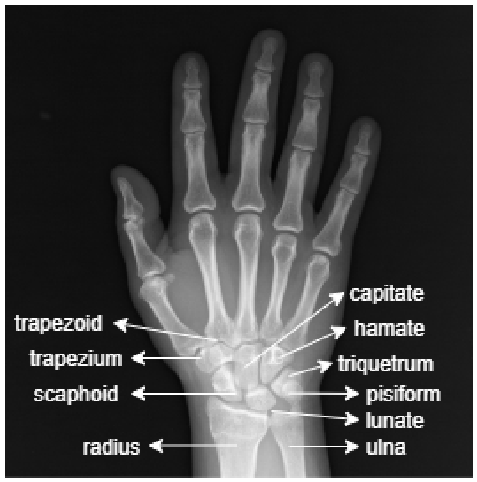 Sensors | Free Full-Text | Fracture Detection in Wrist X-ray Images Using  Deep Learning-Based Object Detection Models