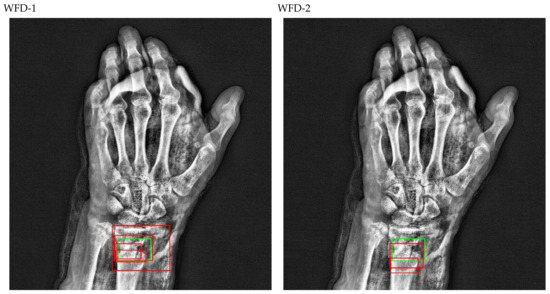 Fracture Detection in Wrist X-ray Images Using Deep Learning-Based 