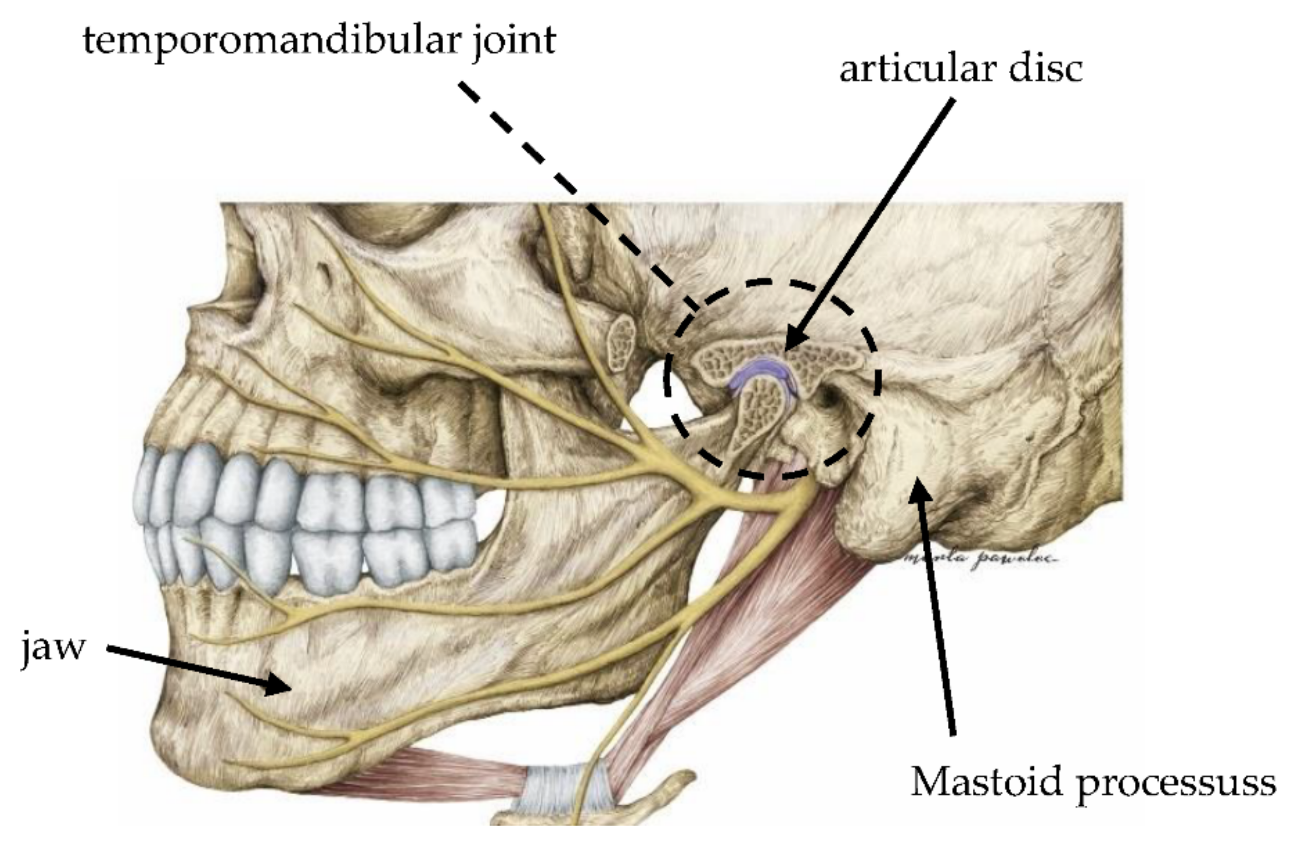 Sensors Free Full-Text sEMG and Vibration System Monitoring for Differential Diagnosis in Temporomandibular Joint Disorders pic