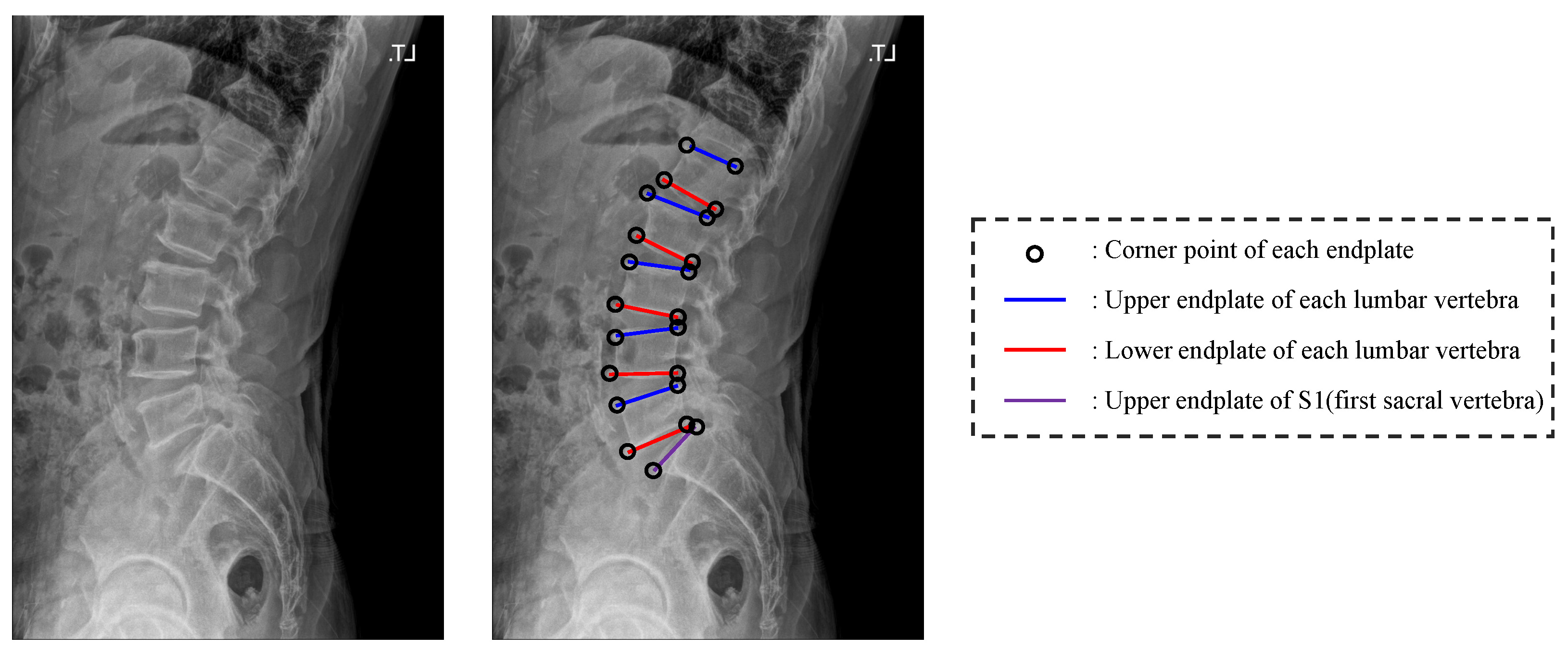 Lumbar Vertebrae X Ray