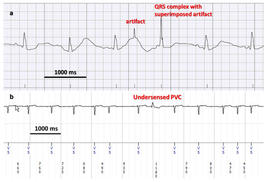 Vivosmart 4 2025 abnormal heart rate