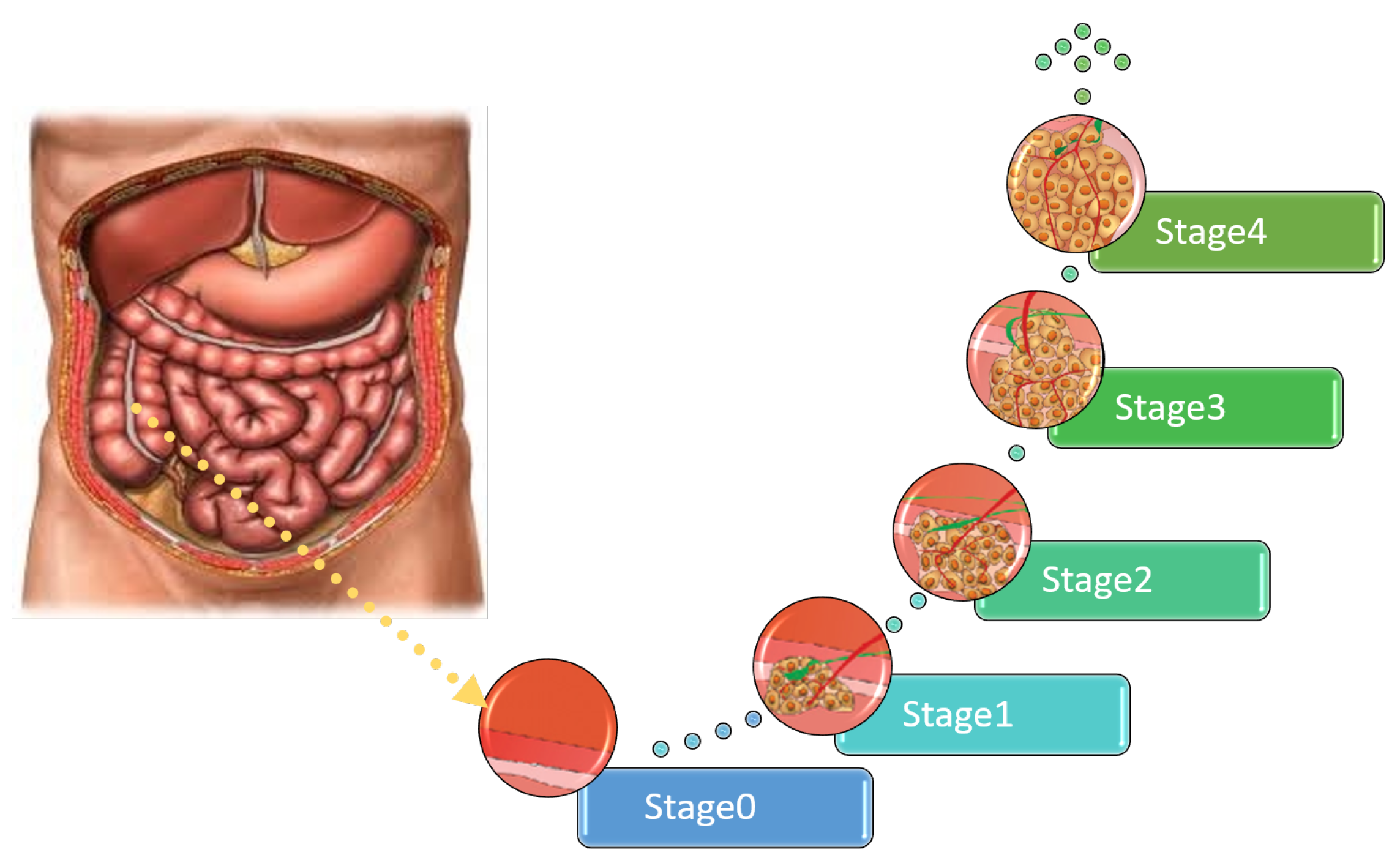 colon cancer stage 0