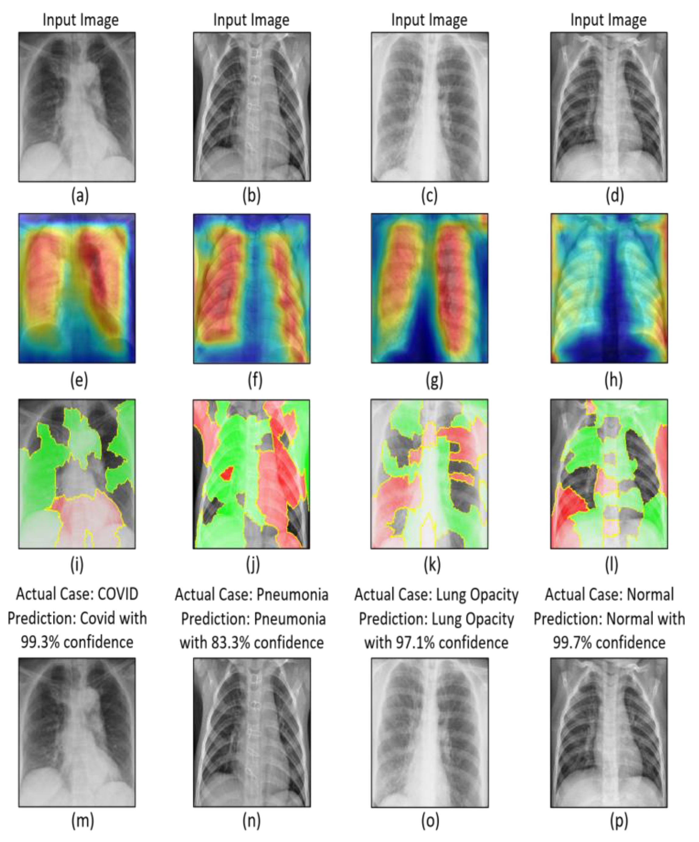 Detection of COVID-19 in X-ray Images Using Densely Connected Squeeze ...