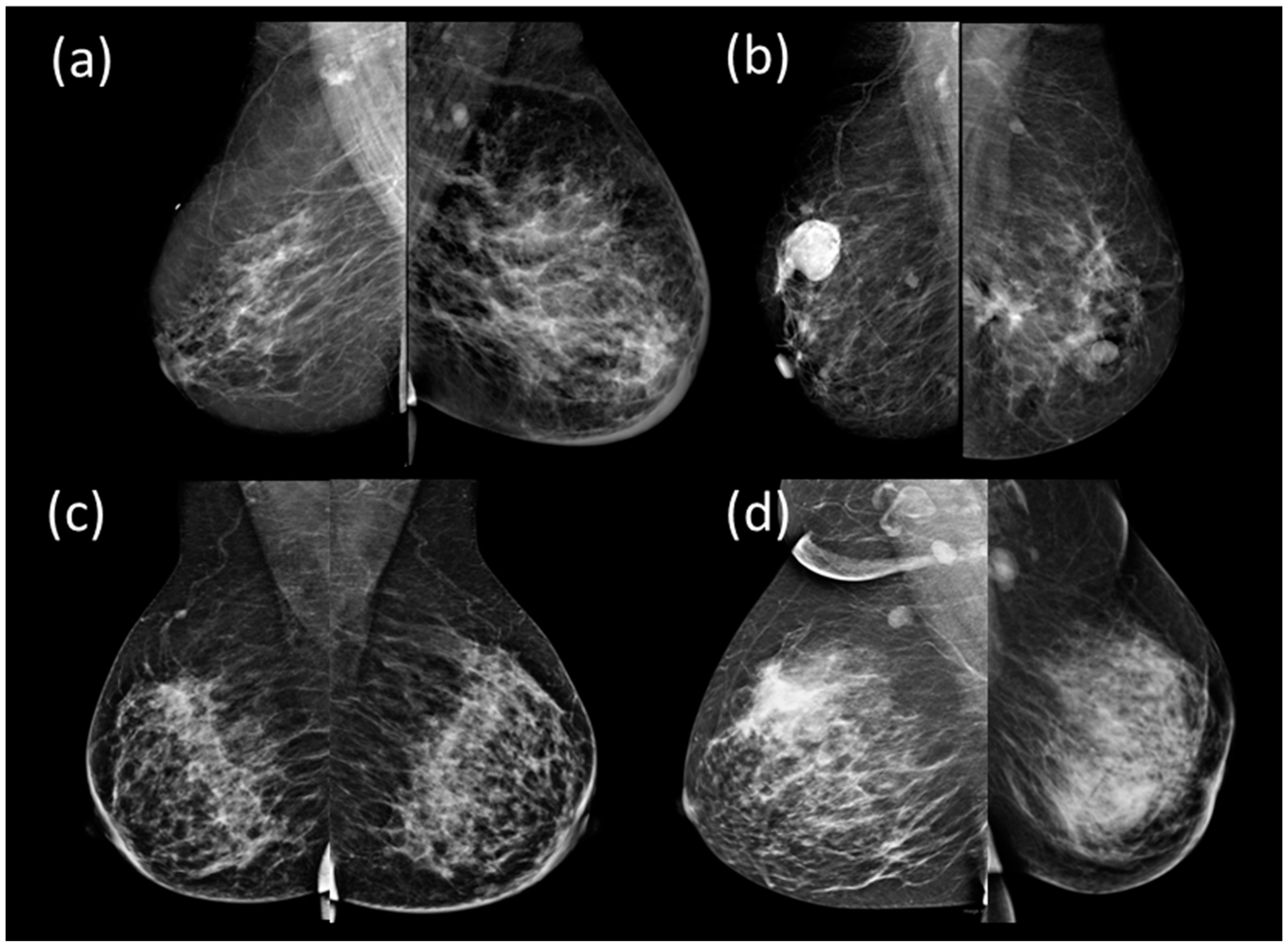 Findings of the right nipple; ultrasound and MR images of the breast. a