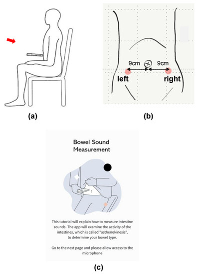 Automated Bowel Sound and Motility Analysis with CNN Using a 