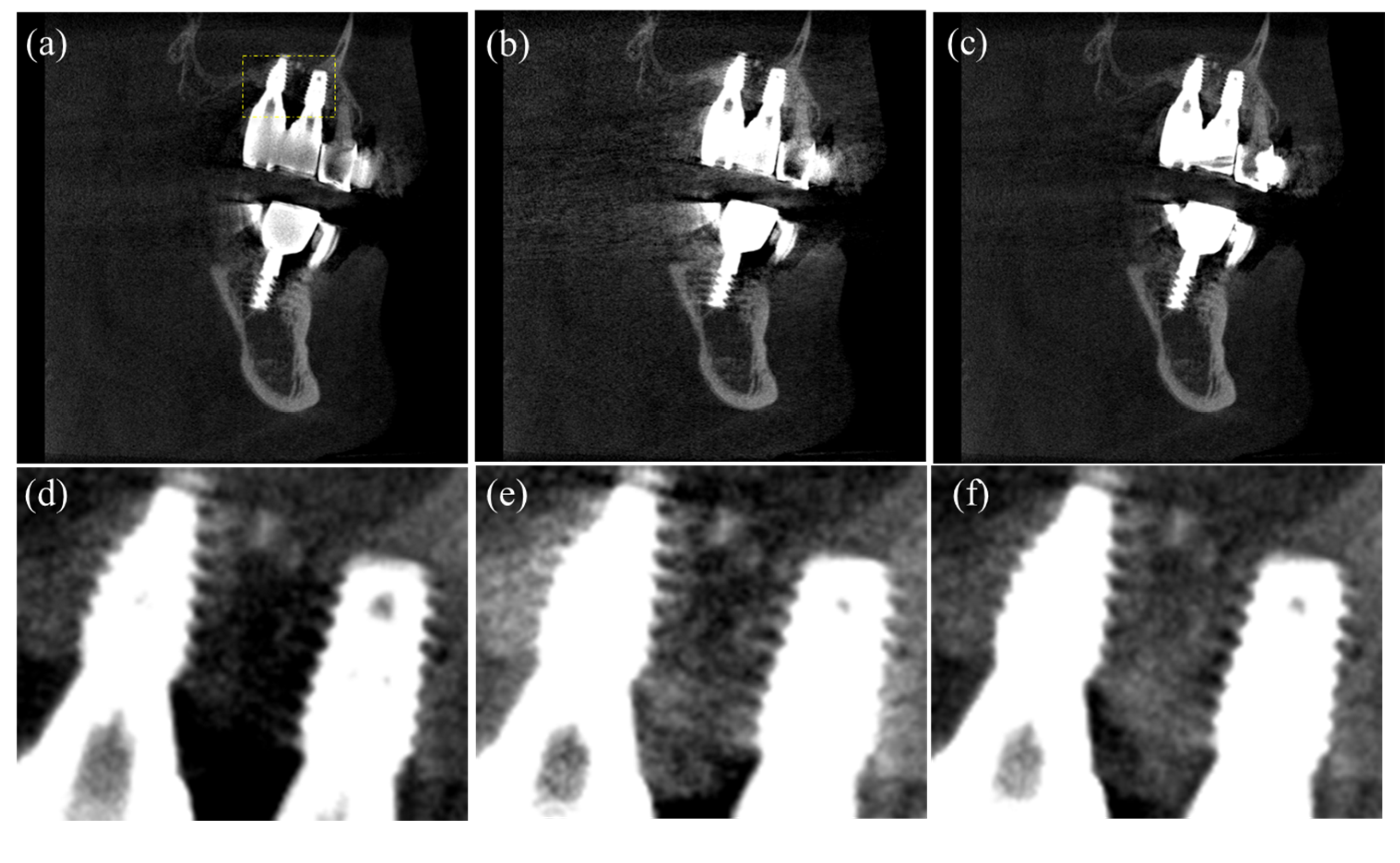 Sensors Free FullText Metal Artifact Reduction in Dental CBCT