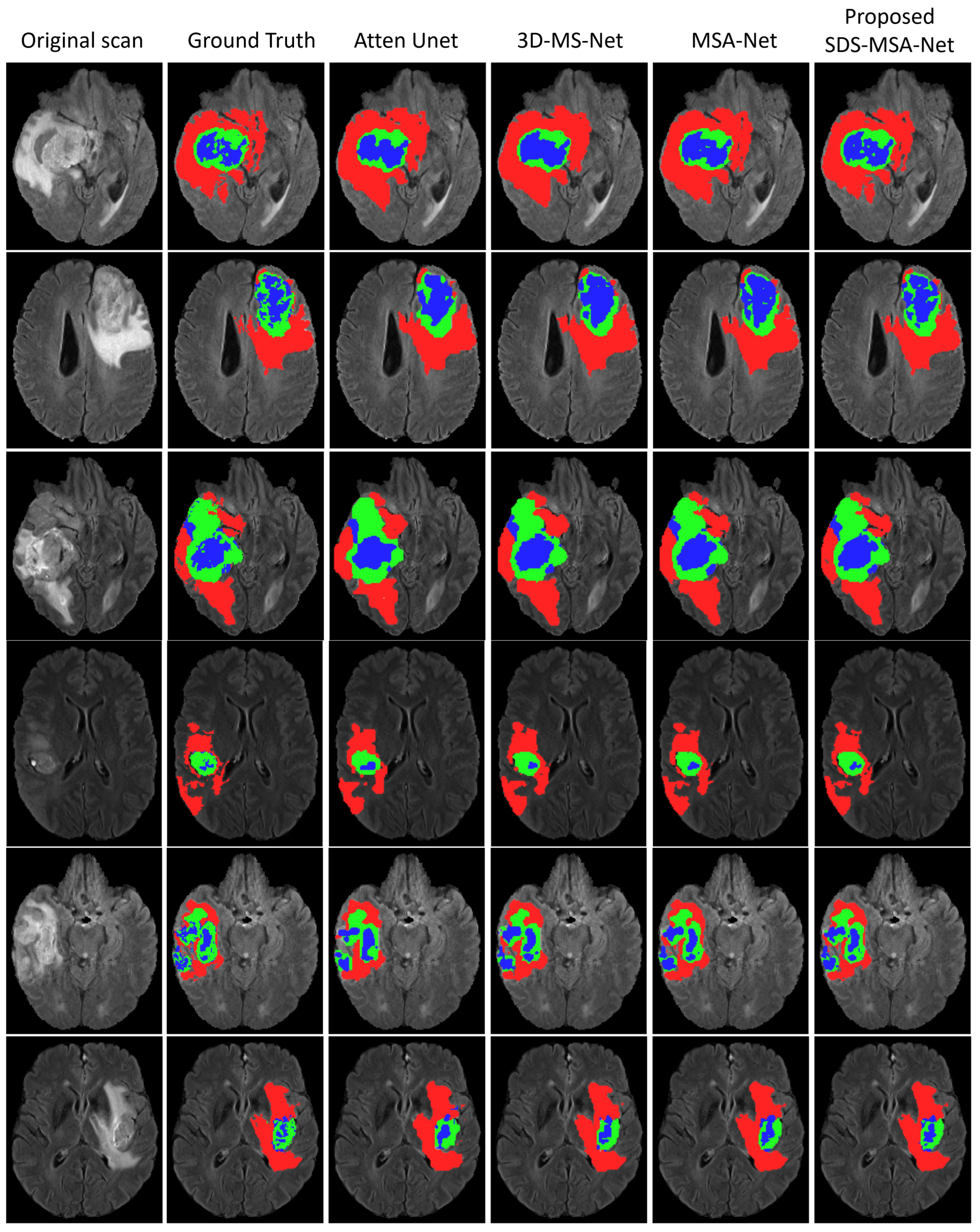 Brain tumor segmentation based on deep learning and an attention mechanism  using MRI multi-modalities brain images
