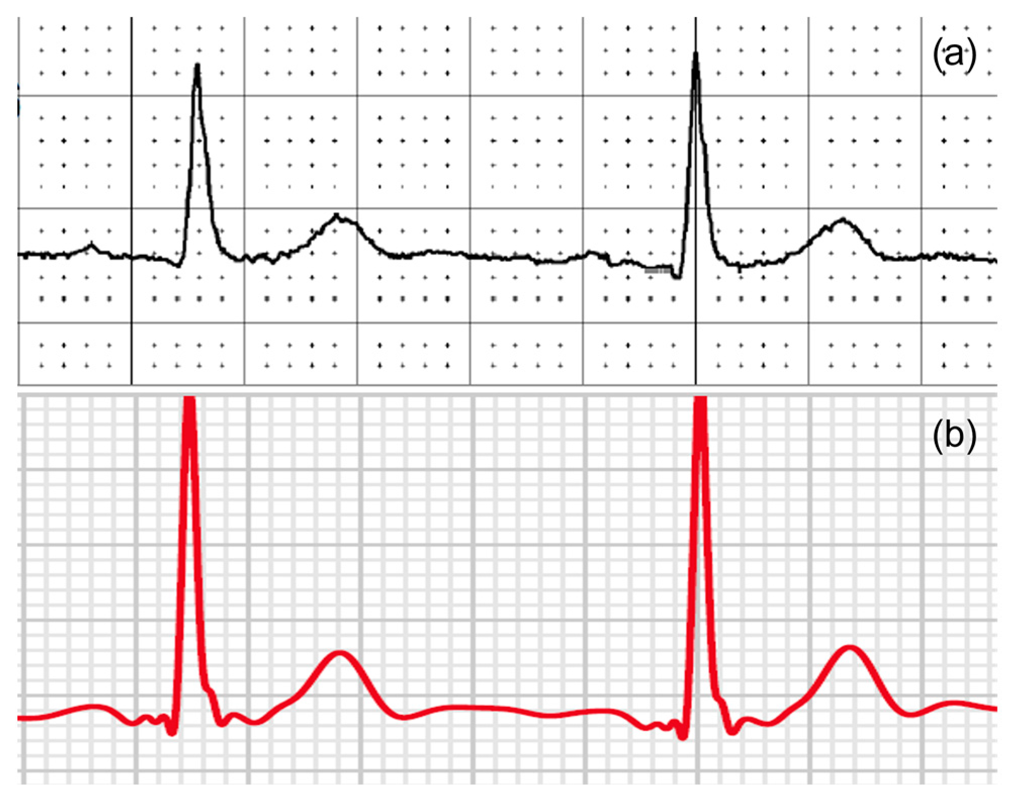 12 lead clearance ecg apple watch