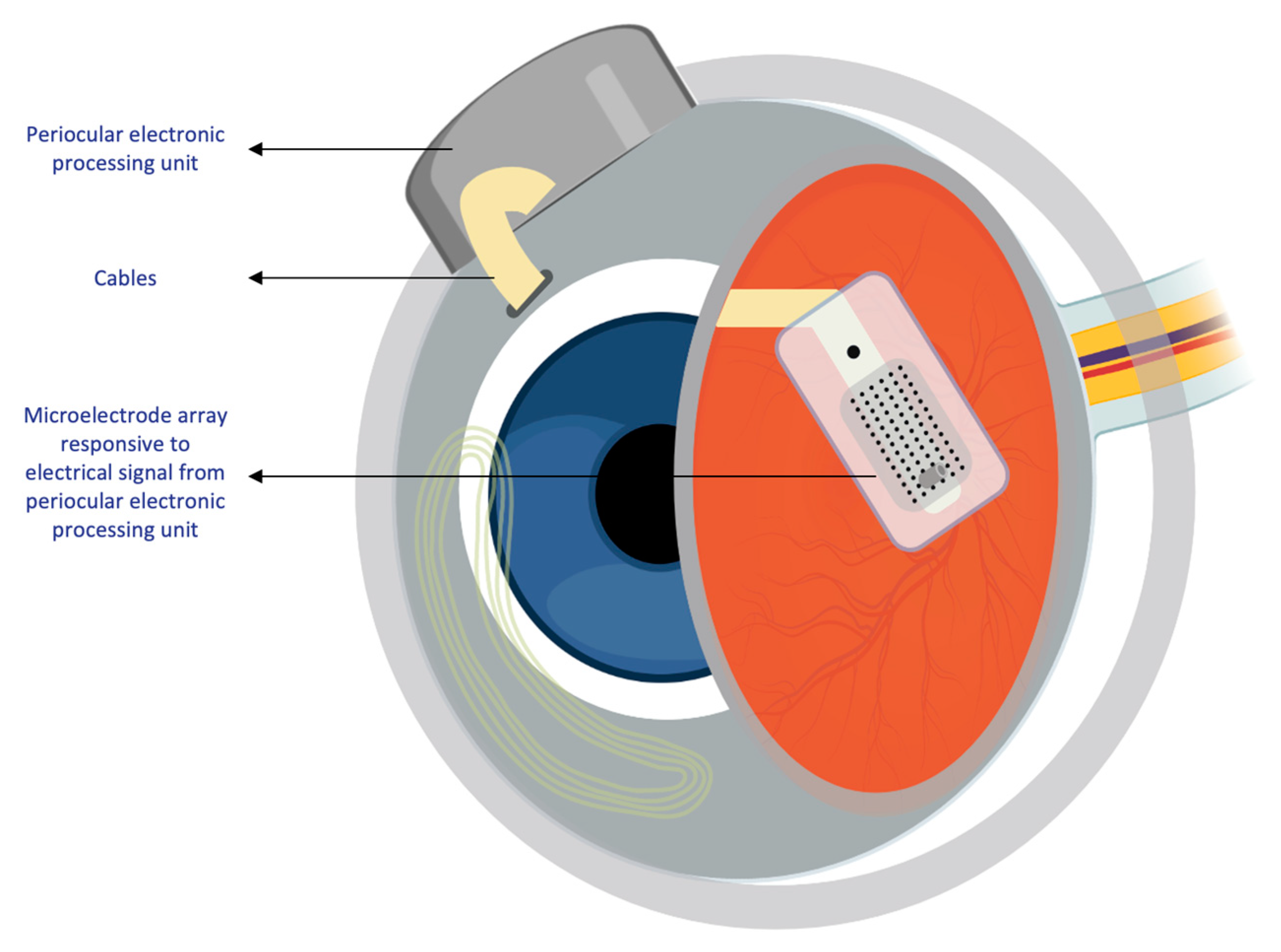 Prosthetic Eye (Artificial eye) - Aravind Eye Care System