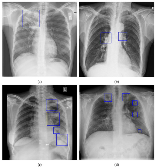 A review on lung boundary detection in chest X-rays International ...