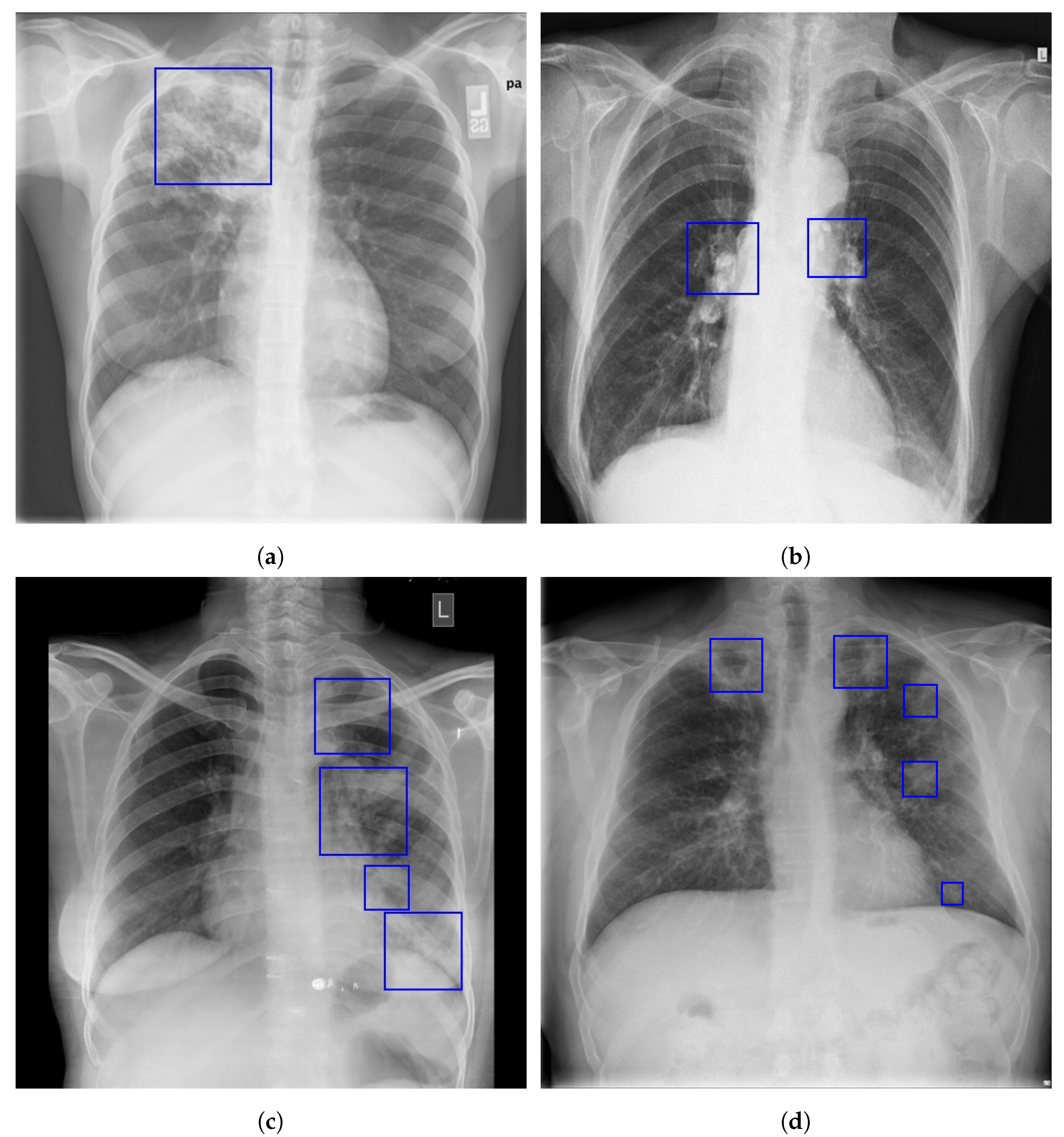 Tuberculosis Vs Pneumonia X Ray