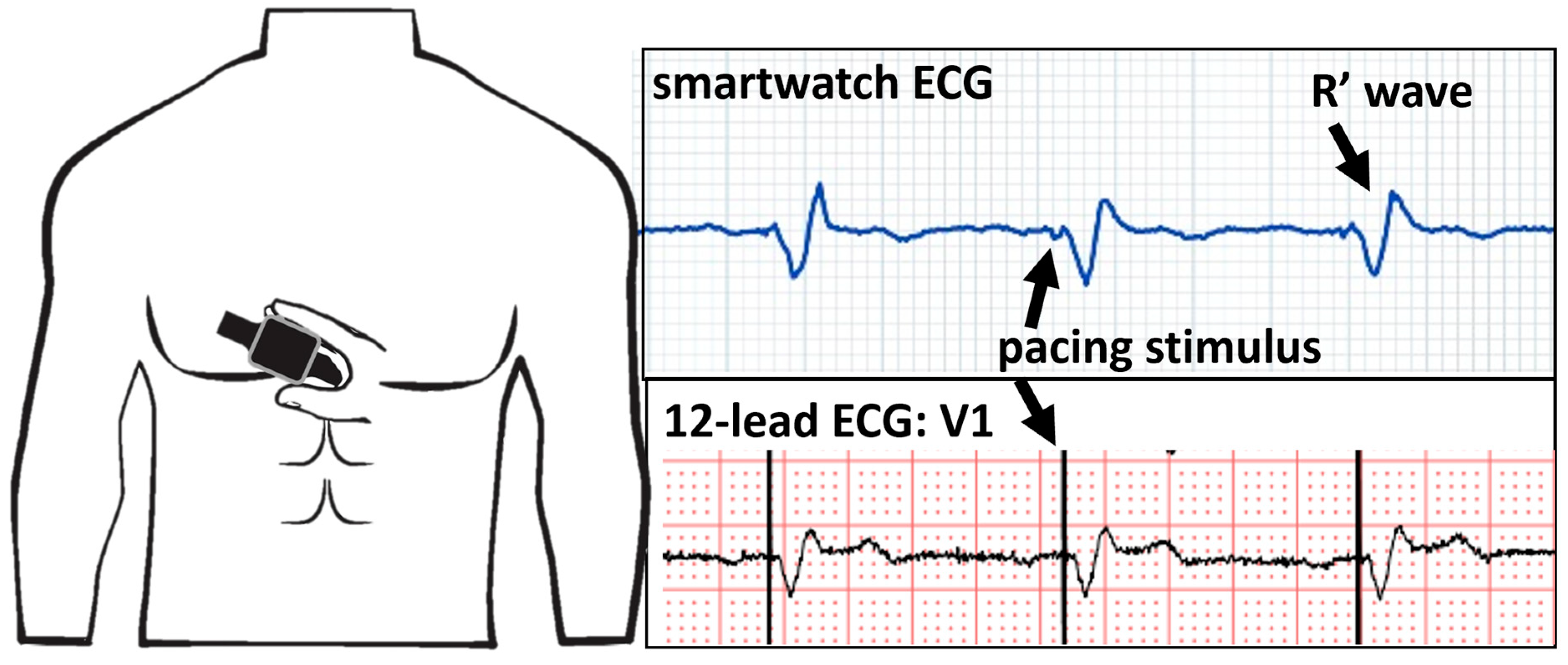 Sensors Free FullText The Use of Electrocardiogram Smartwatches in